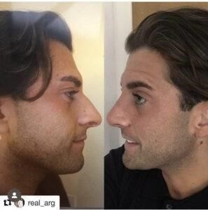 thick skin rhinoplasty expert