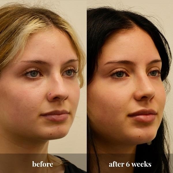 closed rhinoplasty cost