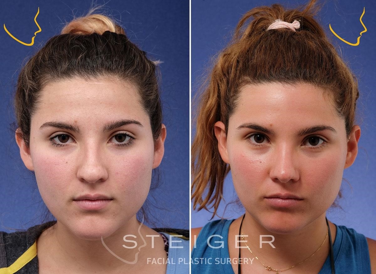 closed rhinoplasty cost