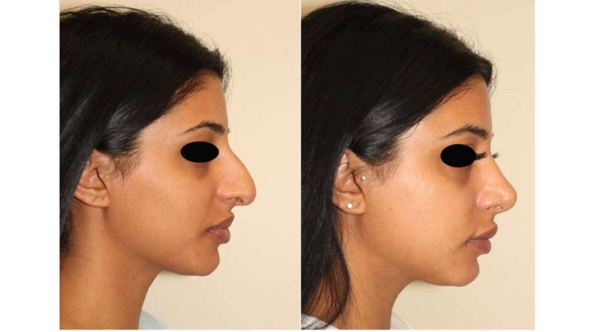 closed rhinoplasty cost